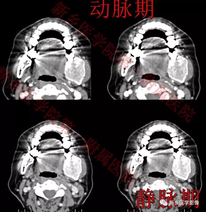 【病例】下颌骨骨化性纤维瘤1例CT影像表现 【病例】下颌骨骨化性纤维瘤1例CT影像表现