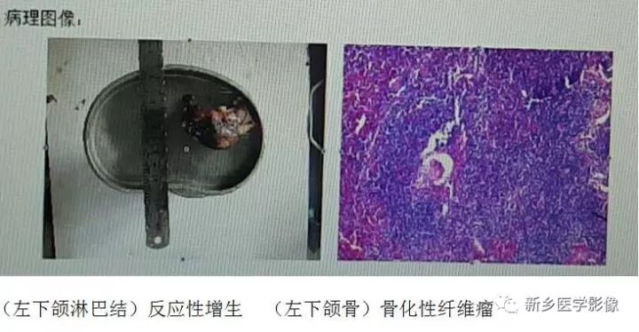 【病例】下颌骨骨化性纤维瘤1例CT影像表现 【病例】下颌骨骨化性纤维瘤1例CT影像表现