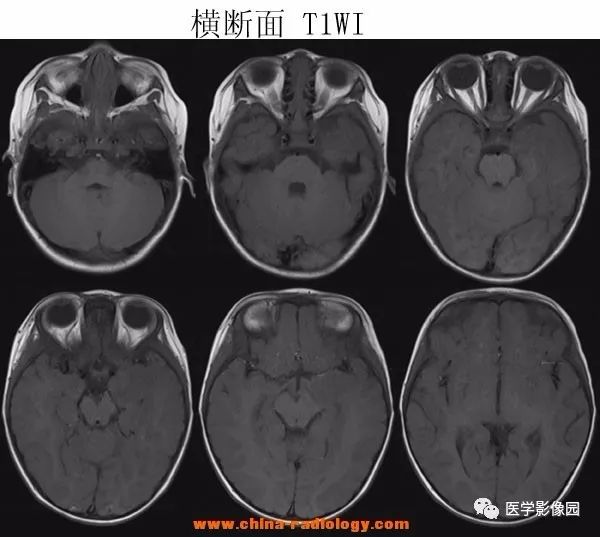【病例】小儿脱髓鞘假瘤1例MR 【病例】小儿脱髓鞘假瘤1例MR
