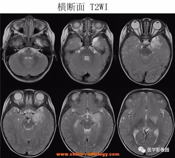 【病例】小儿脱髓鞘假瘤1例MR
