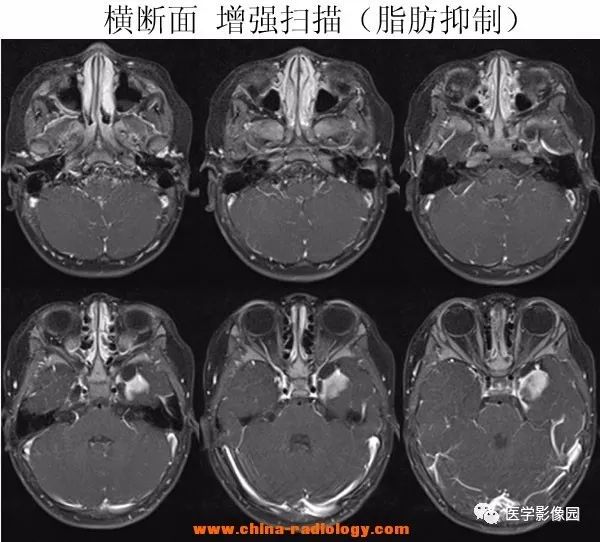 【病例】小儿脱髓鞘假瘤1例MR 【病例】小儿脱髓鞘假瘤1例MR