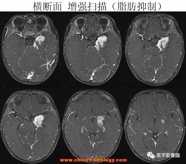 【病例】小儿脱髓鞘假瘤1例MR 【病例】小儿脱髓鞘假瘤1例MR
