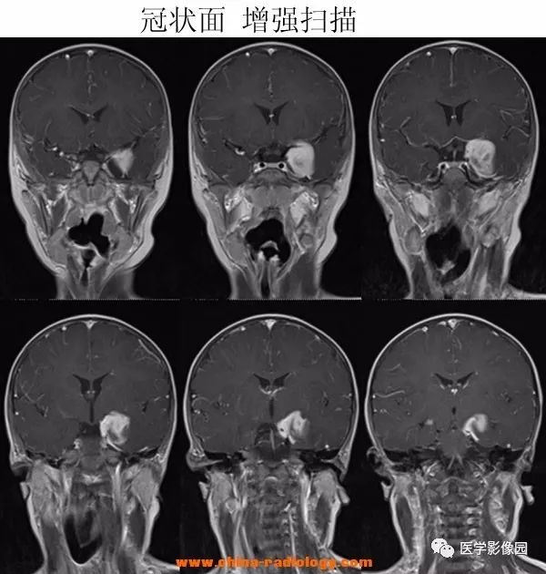 【病例】小儿脱髓鞘假瘤1例MR 【病例】小儿脱髓鞘假瘤1例MR