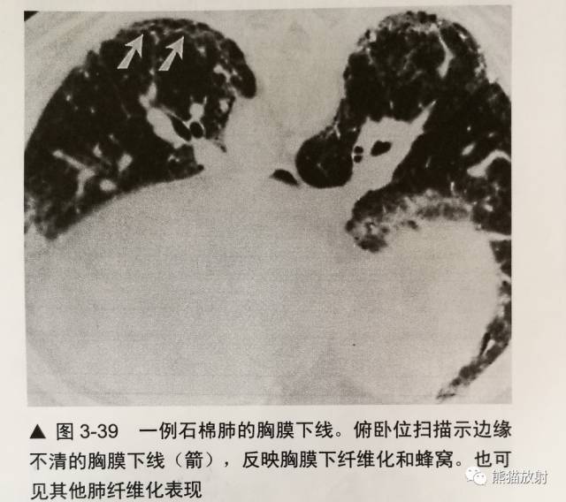 HRCT肺“胸膜下线”的表现及意义 HRCT肺“胸膜下线”的表现及意义