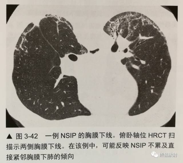 HRCT肺“胸膜下线”的表现及意义 HRCT肺“胸膜下线”的表现及意义