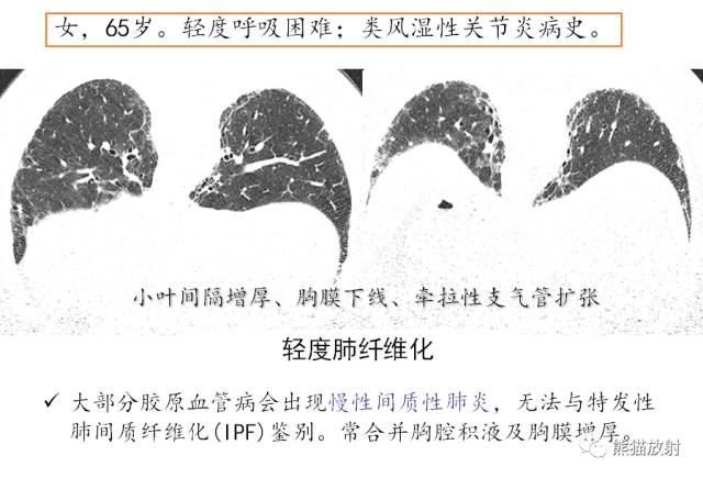 HRCT肺“胸膜下线”的表现及意义 HRCT肺“胸膜下线”的表现及意义