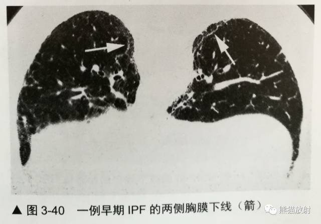 HRCT肺“胸膜下线”的表现及意义 HRCT肺“胸膜下线”的表现及意义