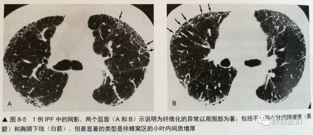HRCT肺“胸膜下线”的表现及意义 HRCT肺“胸膜下线”的表现及意义