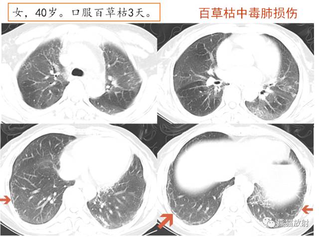 HRCT肺“胸膜下线”的表现及意义 HRCT肺“胸膜下线”的表现及意义
