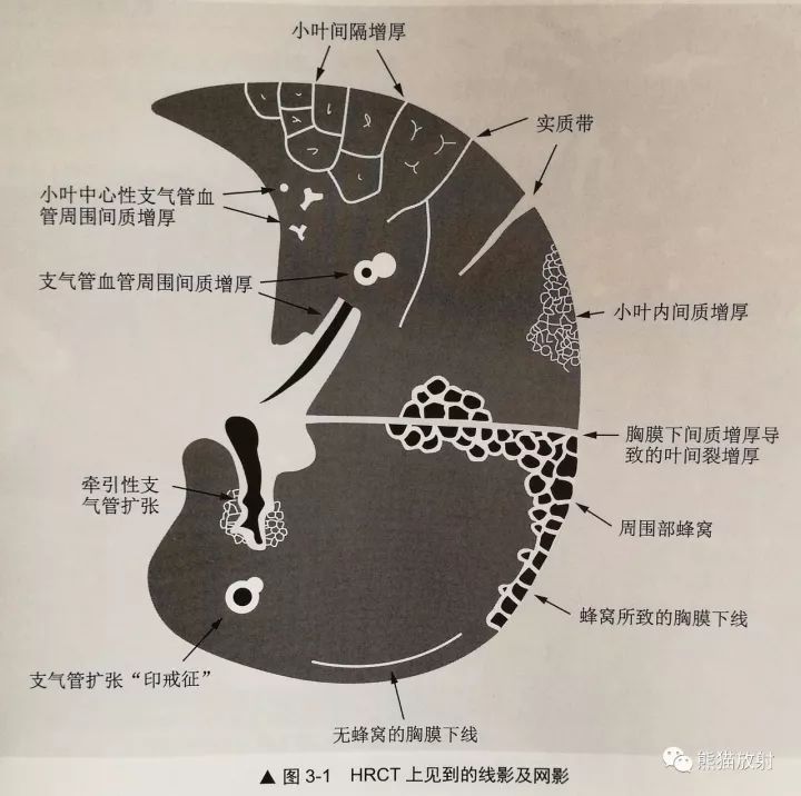 HRCT肺“胸膜下线”的表现及意义 HRCT肺“胸膜下线”的表现及意义