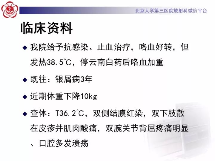【病例】弥漫性肺泡出血1例CT影像表现