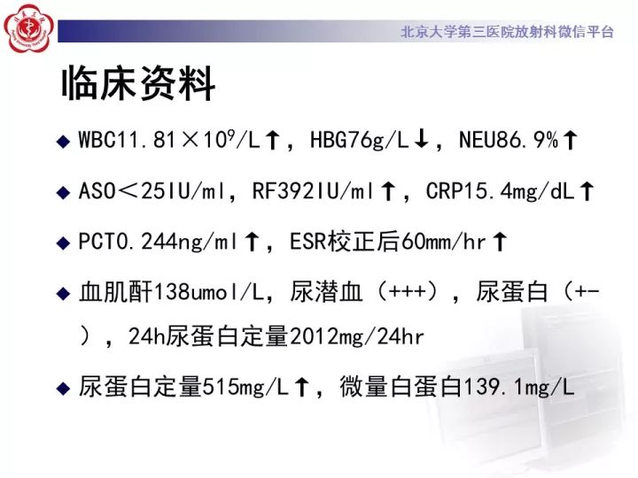 【病例】弥漫性肺泡出血1例CT影像表现
