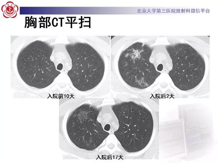 【病例】弥漫性肺泡出血1例CT影像表现