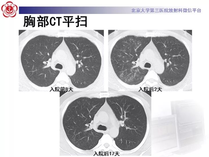 【病例】弥漫性肺泡出血1例CT影像表现