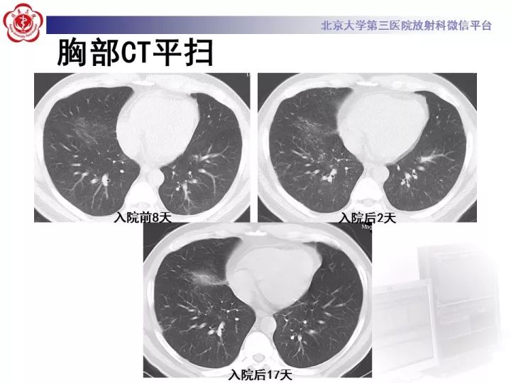 【病例】弥漫性肺泡出血1例CT影像表现