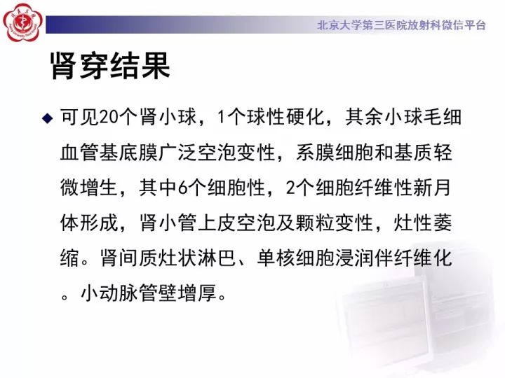 【病例】弥漫性肺泡出血1例CT影像表现