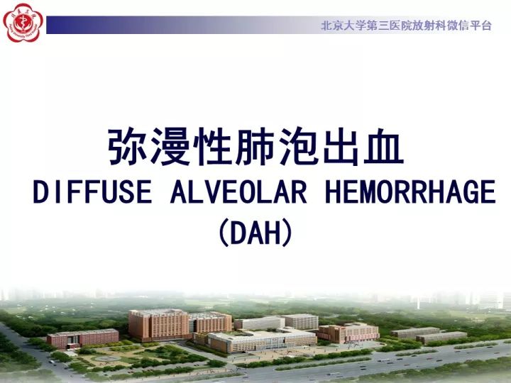 【病例】弥漫性肺泡出血1例CT影像表现