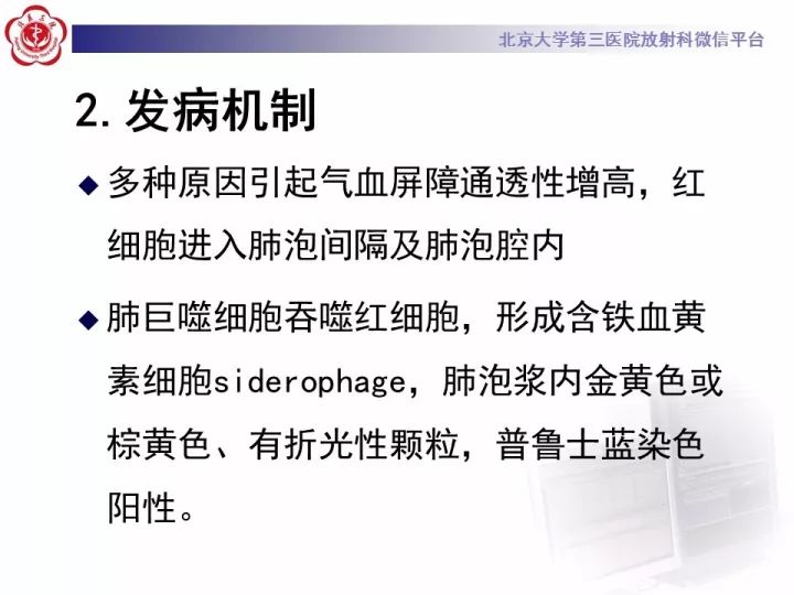 【病例】弥漫性肺泡出血1例CT影像表现