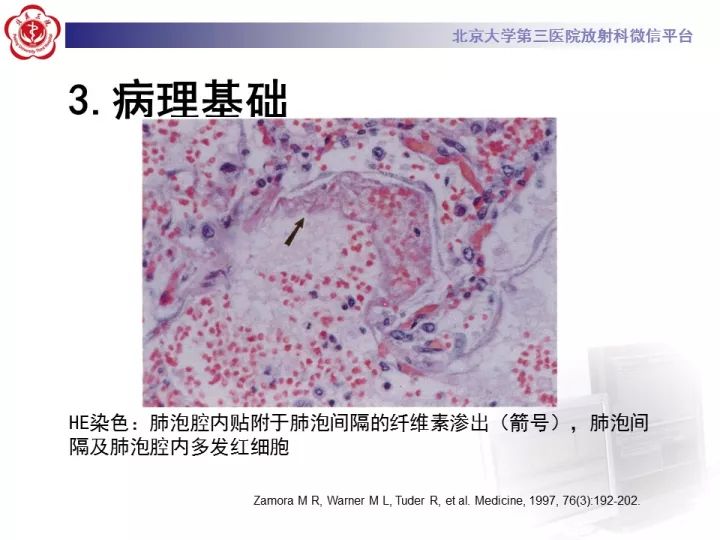 【病例】弥漫性肺泡出血1例CT影像表现