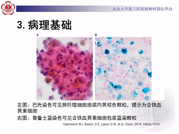 【病例】弥漫性肺泡出血1例CT影像表现
