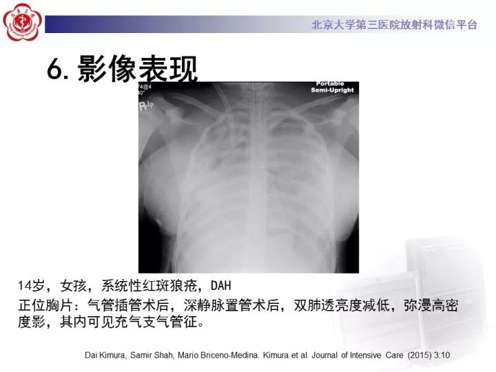 【病例】弥漫性肺泡出血1例CT影像表现