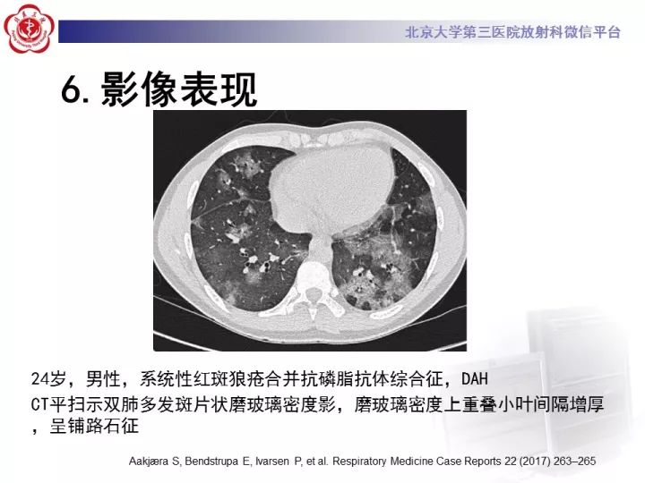 【病例】弥漫性肺泡出血1例CT影像表现