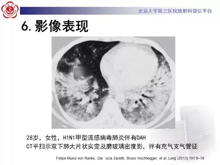 【病例】弥漫性肺泡出血1例CT影像表现