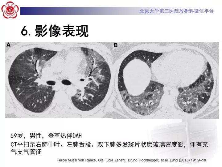 【病例】弥漫性肺泡出血1例CT影像表现