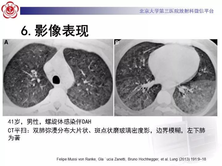 【病例】弥漫性肺泡出血1例CT影像表现
