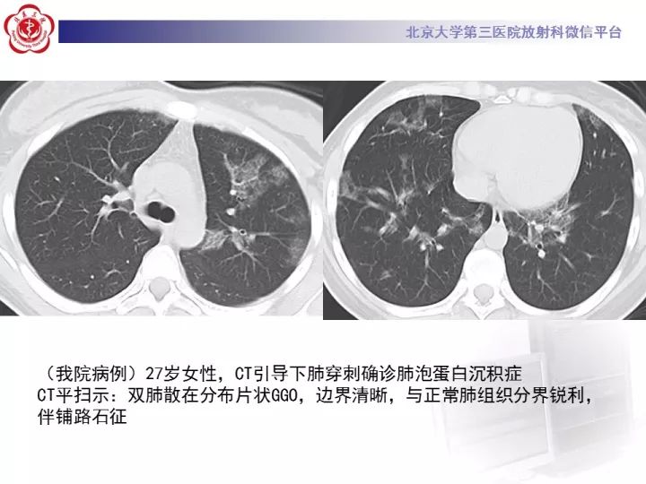 【病例】弥漫性肺泡出血1例CT影像表现