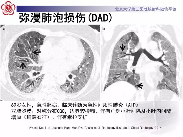 【病例】弥漫性肺泡出血1例CT影像表现