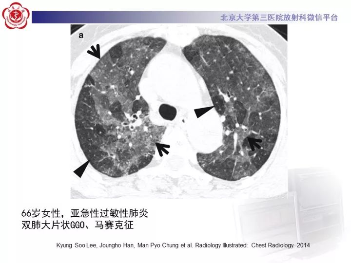 【病例】弥漫性肺泡出血1例CT影像表现