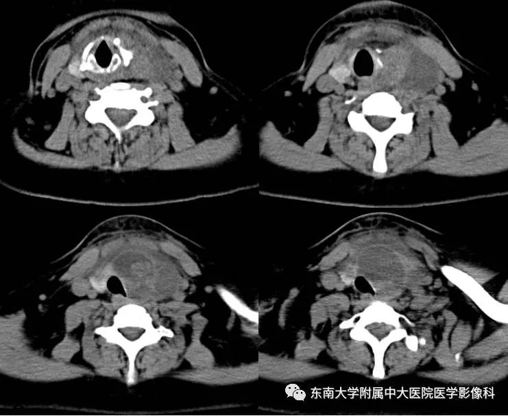 【病例】甲状腺乳头状癌1例CT影像诊断