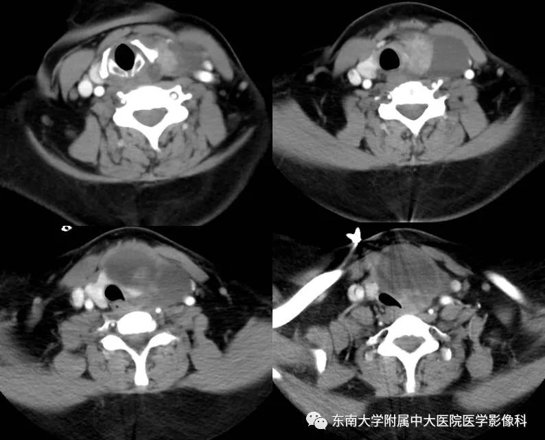 【病例】甲状腺乳头状癌1例CT影像诊断
