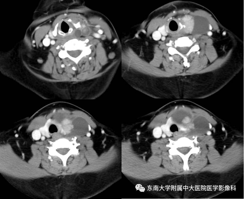 【病例】甲状腺乳头状癌1例CT影像诊断