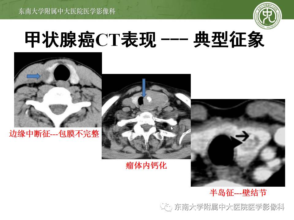 【病例】甲状腺乳头状癌1例CT影像诊断