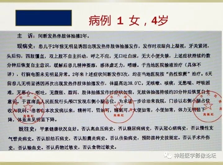 【病例】右侧小脑星形细胞瘤II级1例MR