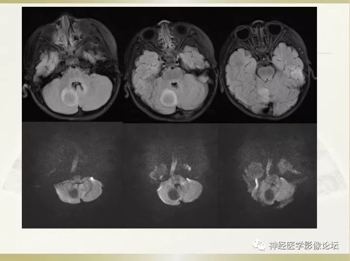【病例】右侧小脑星形细胞瘤II级1例MR