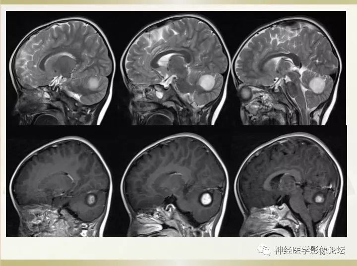 【病例】右侧小脑星形细胞瘤II级1例MR