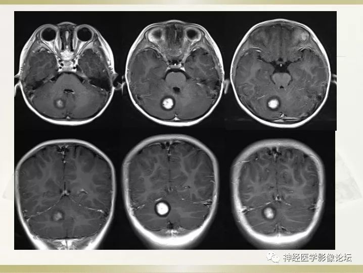 【病例】右侧小脑星形细胞瘤II级1例MR