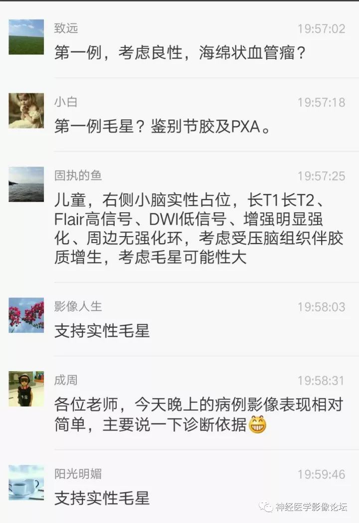 【病例】右侧小脑星形细胞瘤II级1例MR