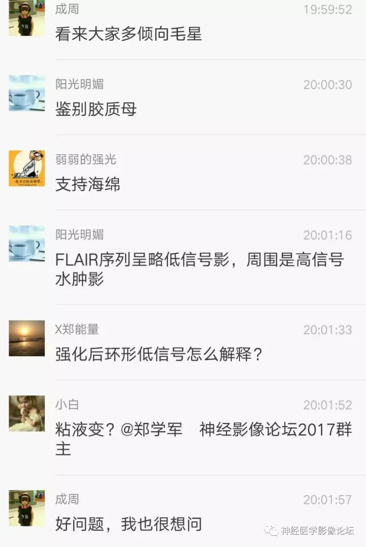 【病例】右侧小脑星形细胞瘤II级1例MR