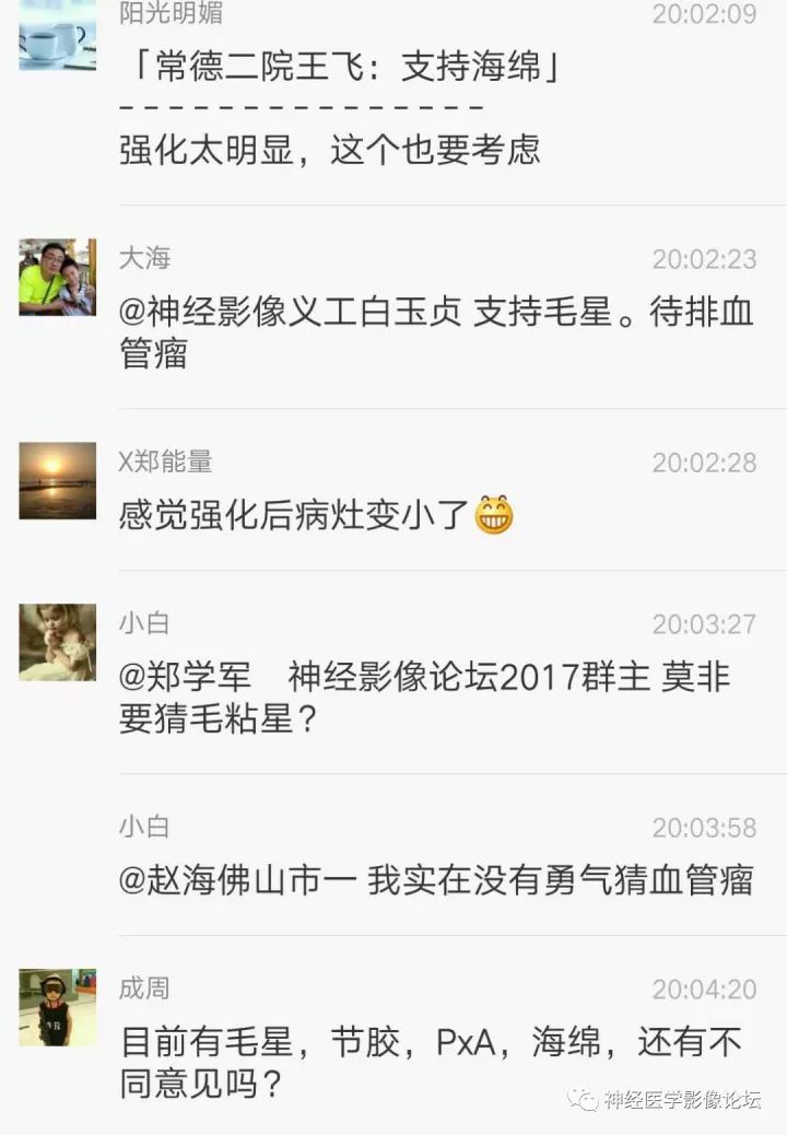【病例】右侧小脑星形细胞瘤II级1例MR