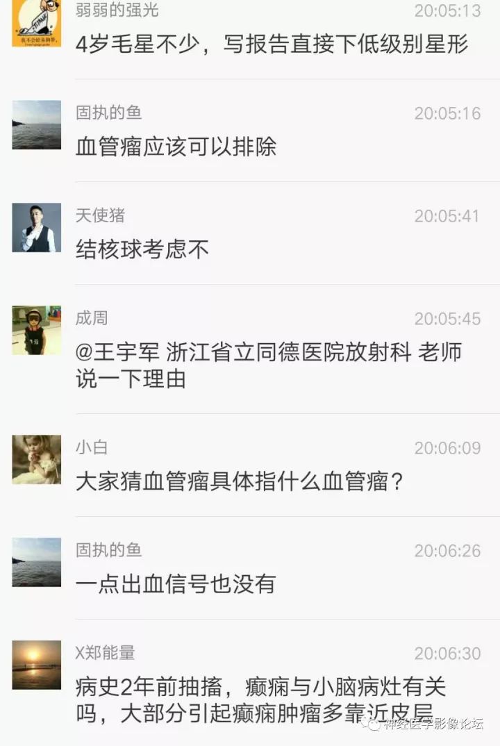 【病例】右侧小脑星形细胞瘤II级1例MR