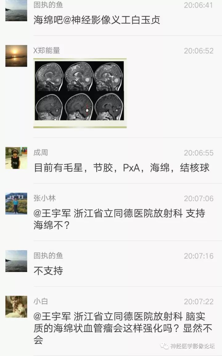 【病例】右侧小脑星形细胞瘤II级1例MR