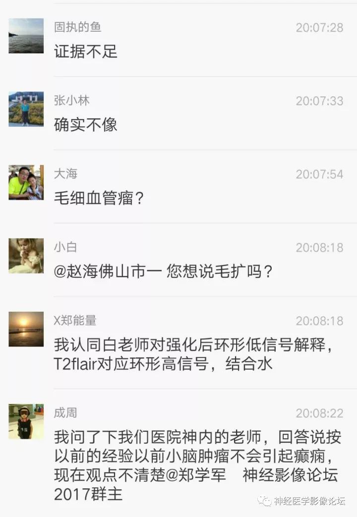 【病例】右侧小脑星形细胞瘤II级1例MR