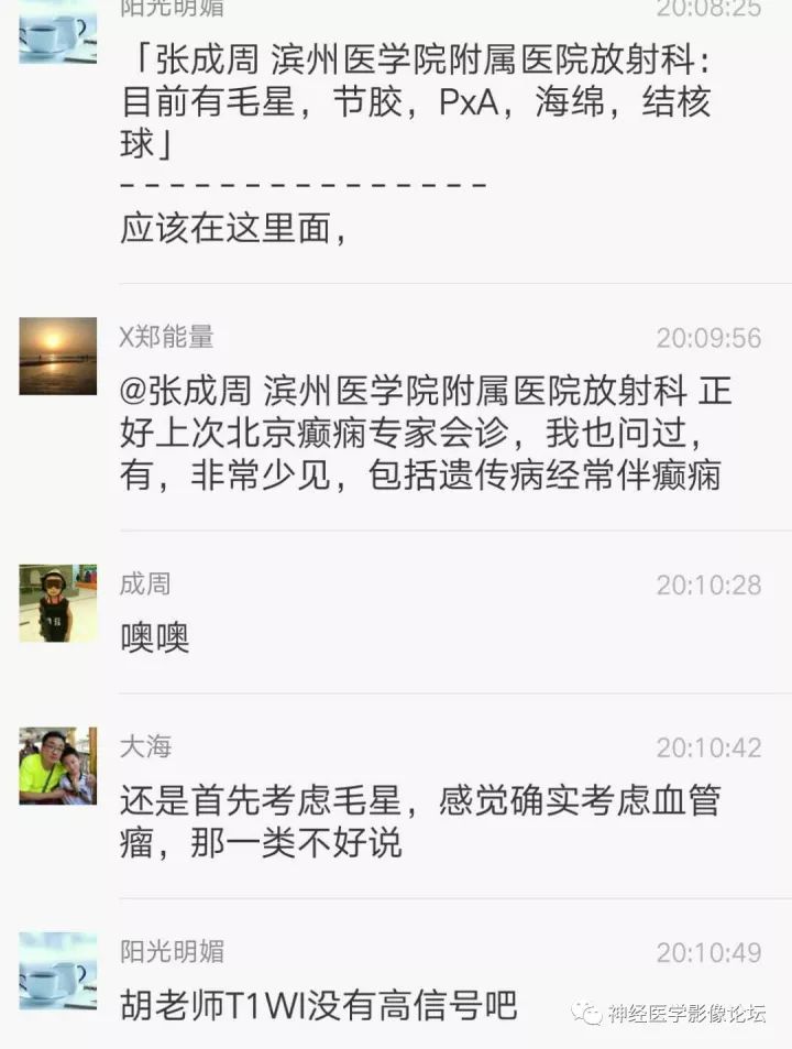 【病例】右侧小脑星形细胞瘤II级1例MR