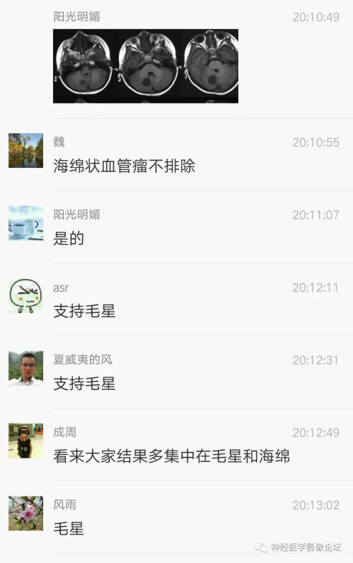 【病例】右侧小脑星形细胞瘤II级1例MR