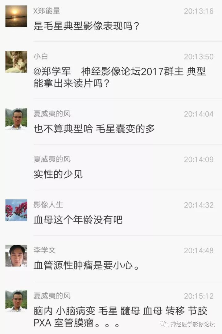 【病例】右侧小脑星形细胞瘤II级1例MR