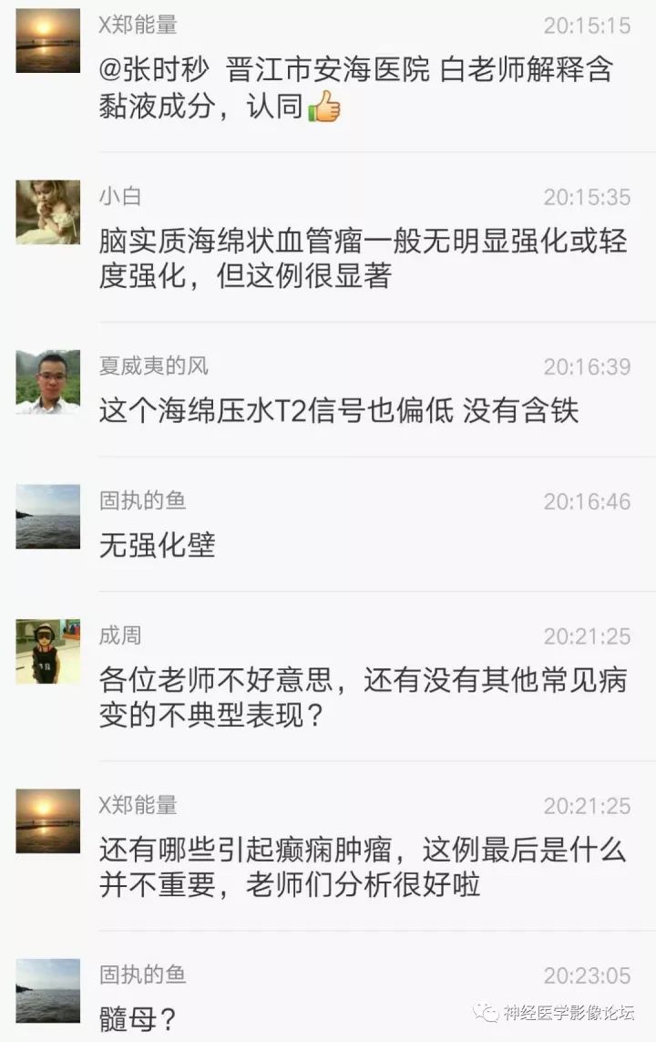 【病例】右侧小脑星形细胞瘤II级1例MR